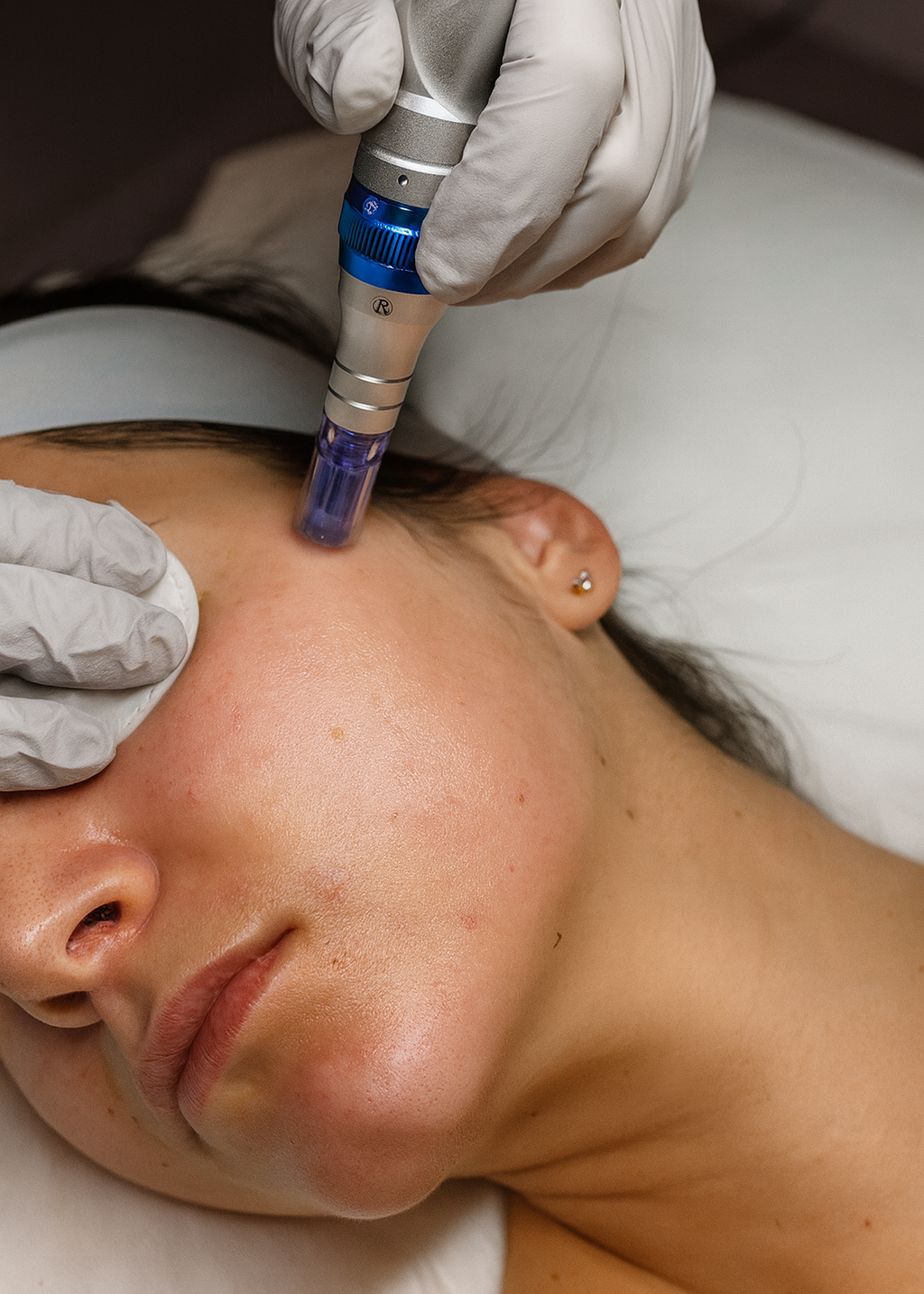 MICRONEEDLING