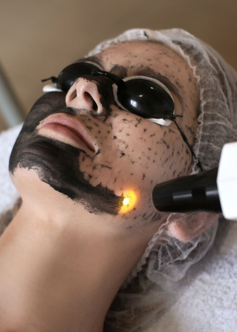 CARBON PEELING