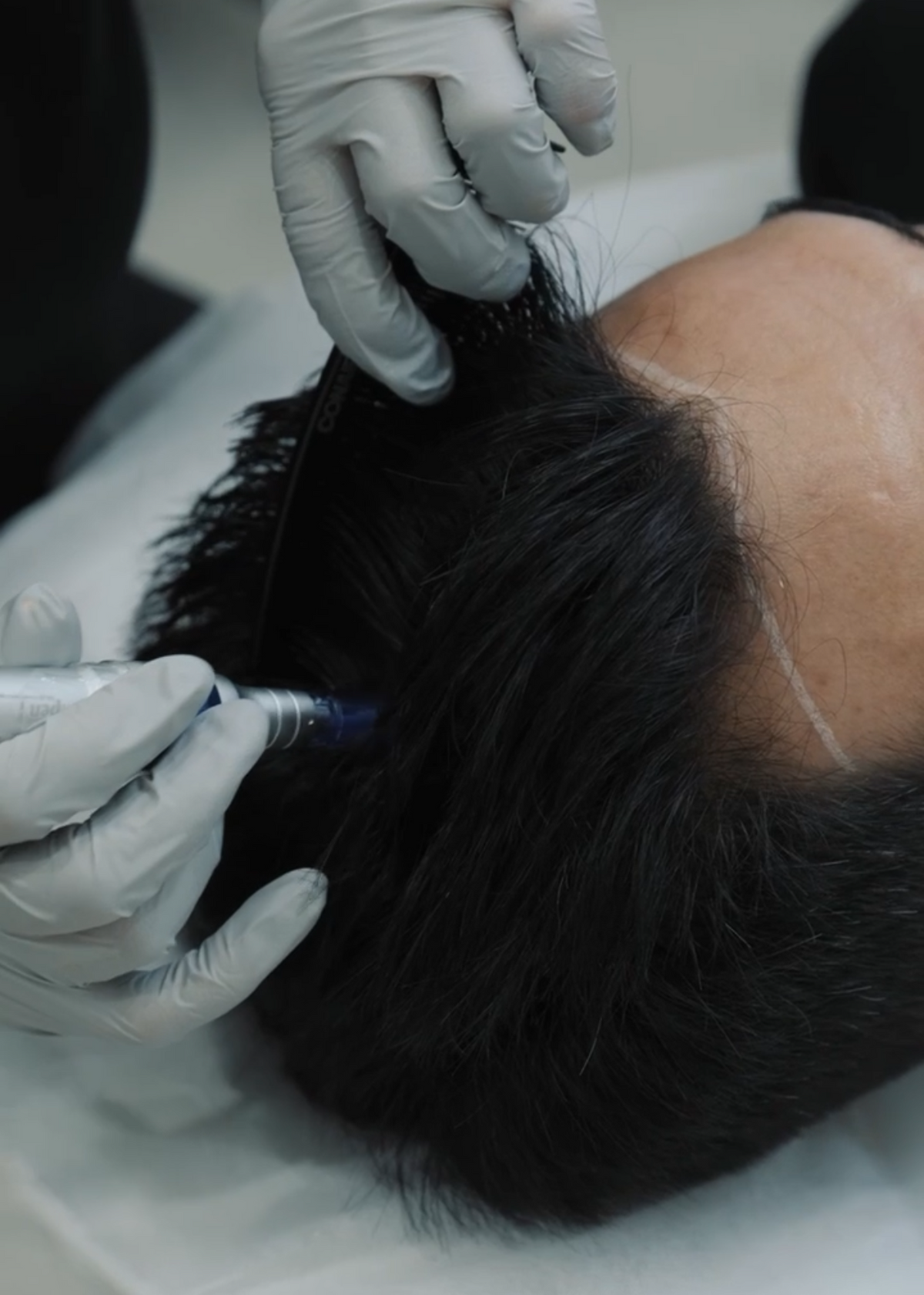 HAIR LOSS MESOTHERAPY