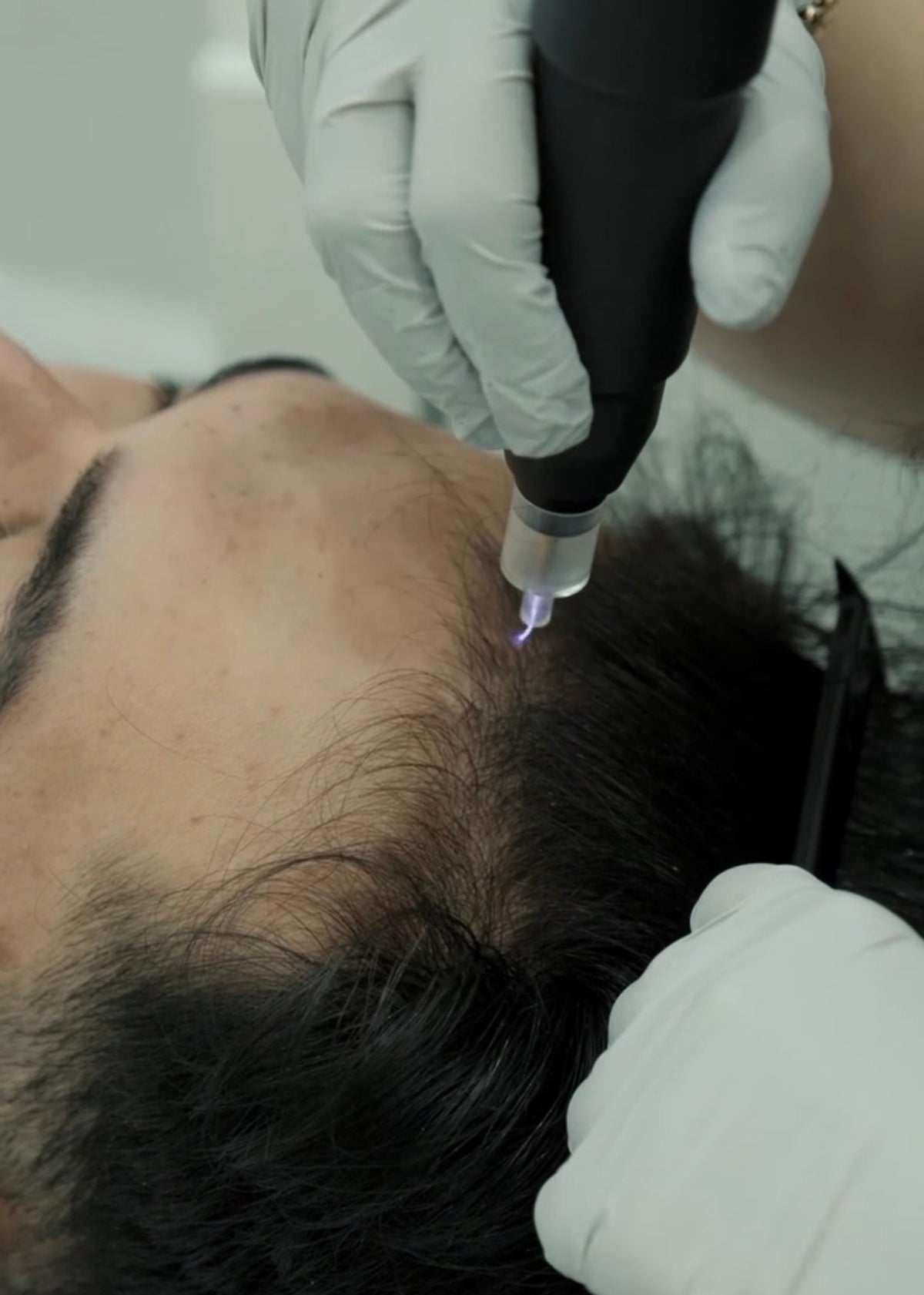 HAIR LOSS MESOTHERAPY